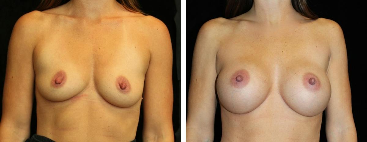 Breast Asymmetry Before & After Gallery - Patient 404156 - Image 1