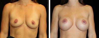 Breast Asymmetry Before & After Gallery - Patient 404156 - Image 1