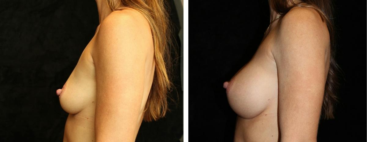 Breast Asymmetry Before & After Gallery - Patient 404156 - Image 3