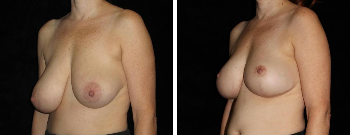 Breast Asymmetry Before & After Gallery - Patient 169978 - Image 2