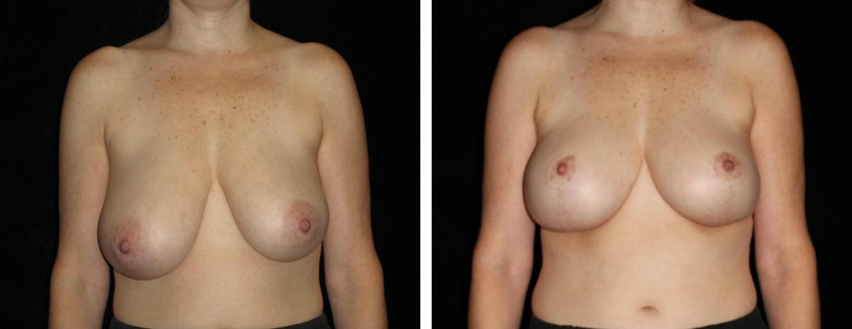 Breast Asymmetry Before & After Gallery - Patient 169978 - Image 1