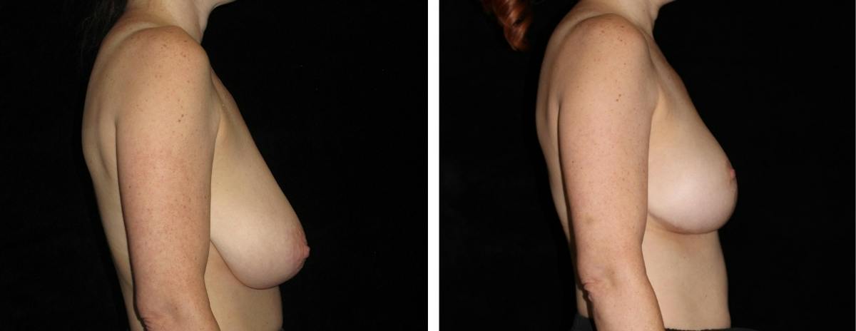 Breast Asymmetry Before & After Gallery - Patient 169978 - Image 3