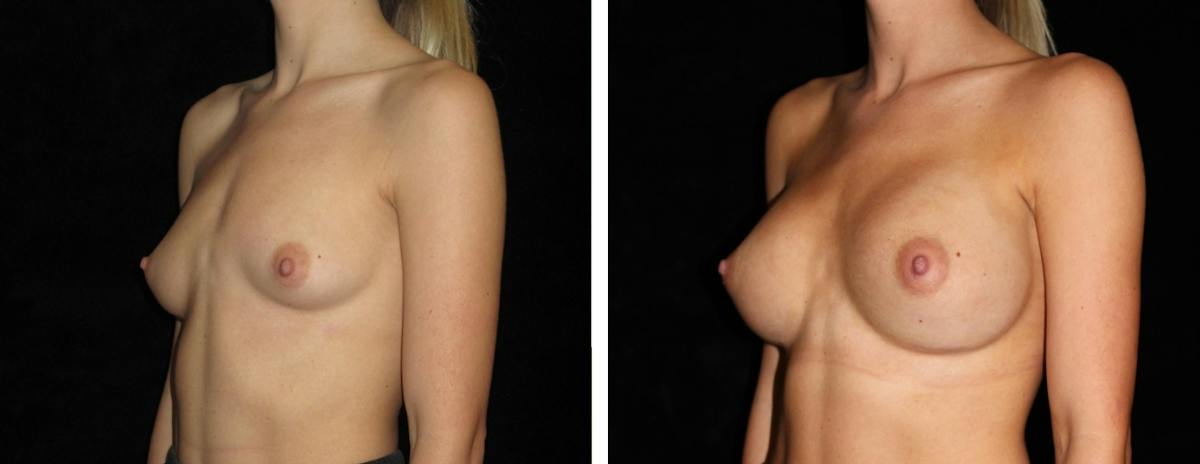 Breast Asymmetry Before & After Gallery - Patient 378455 - Image 2