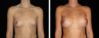 Breast Asymmetry Before & After Gallery - Patient 378455 - Image 1