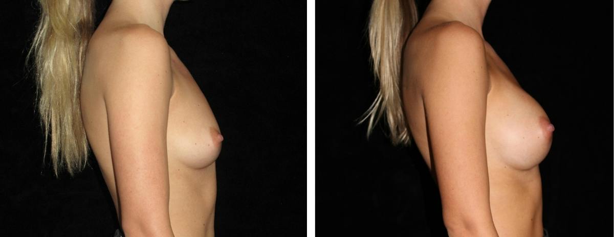 Breast Asymmetry Before & After Gallery - Patient 378455 - Image 3