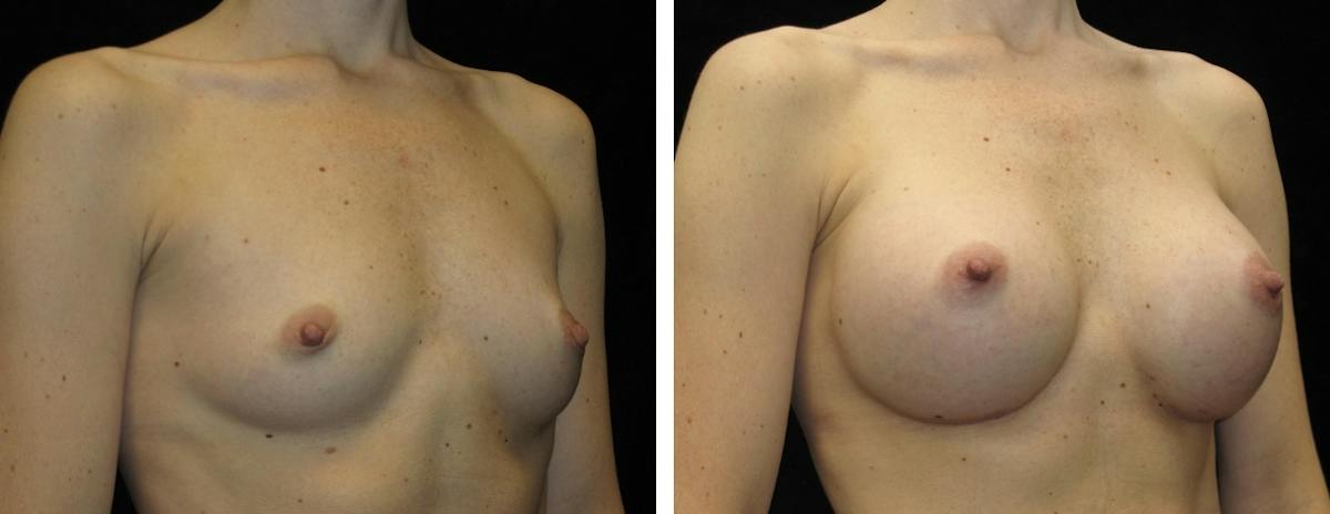 Breast Augmentation Before & After Gallery - Patient 400087 - Image 2
