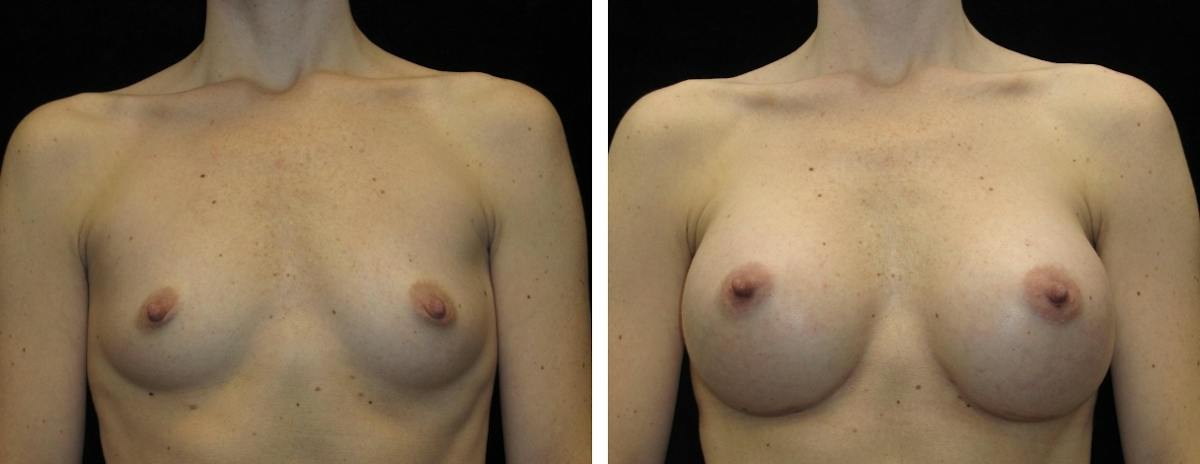 Breast Augmentation Before & After Gallery - Patient 400087 - Image 1