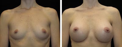 Breast Augmentation Before & After Gallery - Patient 400087 - Image 1