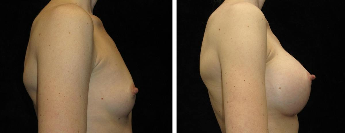 Breast Augmentation Before & After Gallery - Patient 400087 - Image 3
