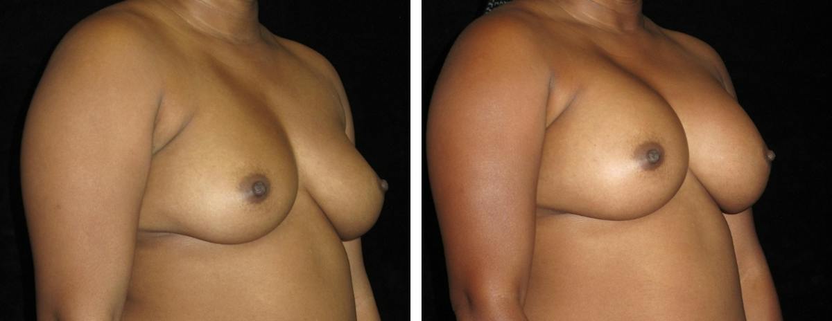 Breast Augmentation Before & After Gallery - Patient 114848 - Image 2