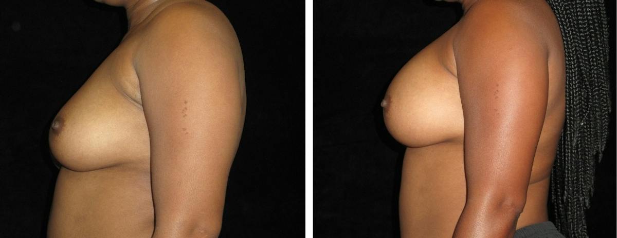 Breast Augmentation Before & After Gallery - Patient 114848 - Image 3