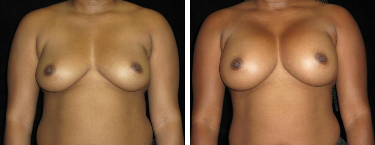 Breast Augmentation Before & After Gallery - Patient 114848 - Image 1