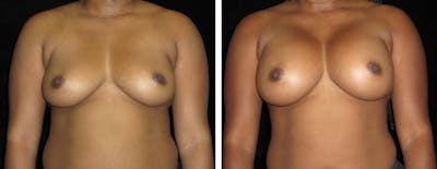 Breast Augmentation Before & After Gallery - Patient 114848 - Image 1