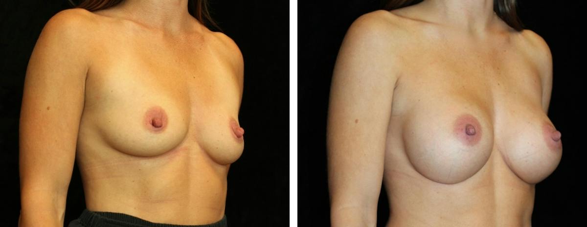 Breast Augmentation Before & After Gallery - Patient 195275 - Image 2