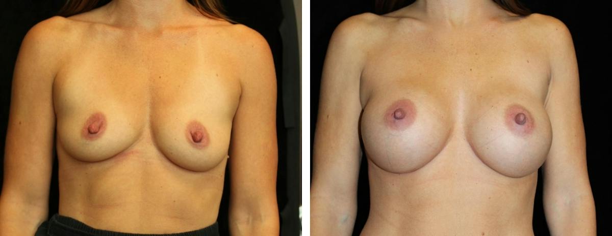 Breast Augmentation Before & After Gallery - Patient 195275 - Image 1