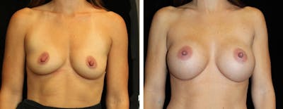 Breast Augmentation Before & After Gallery - Patient 195275 - Image 1