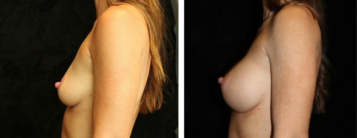 Breast Augmentation Before & After Gallery - Patient 195275 - Image 3