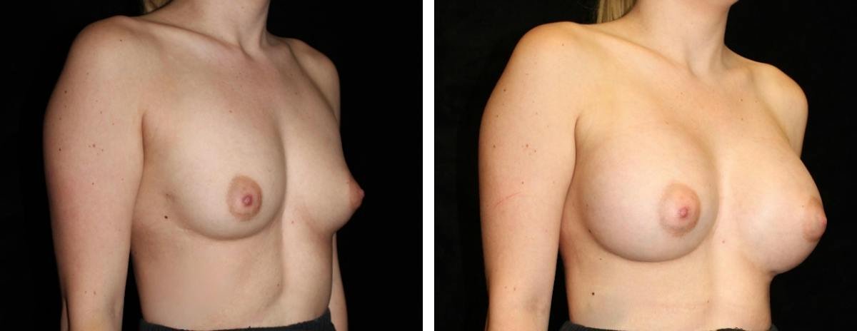 Breast Augmentation Before & After Gallery - Patient 368724 - Image 2