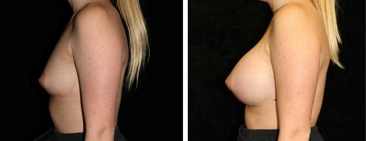Breast Augmentation Before & After Gallery - Patient 368724 - Image 3