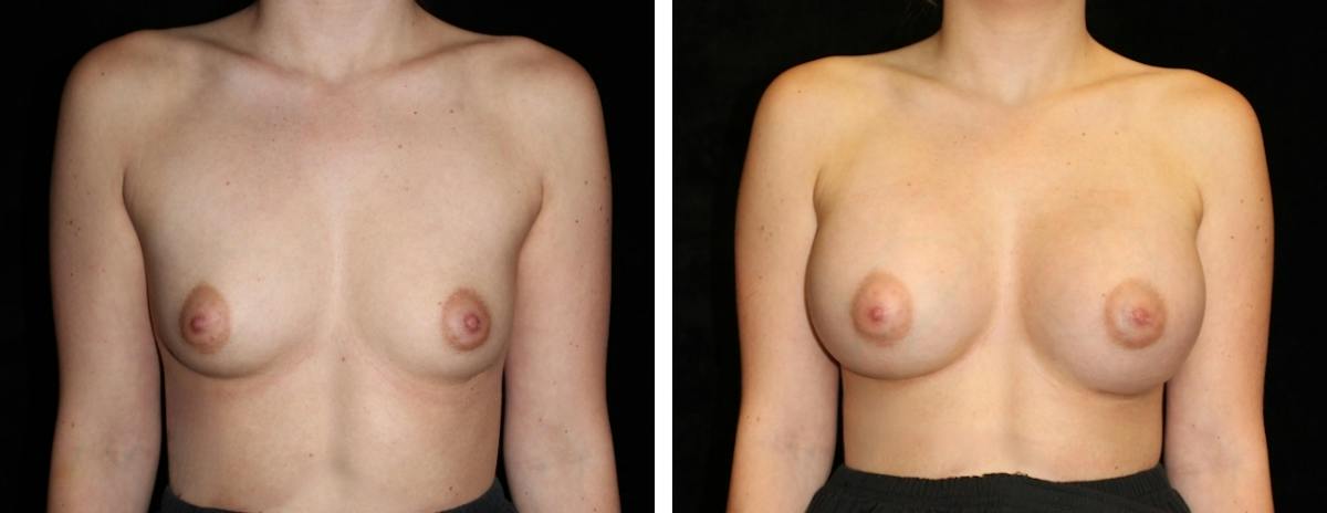 Breast Augmentation Before & After Gallery - Patient 368724 - Image 1