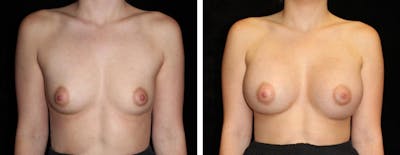 Breast Augmentation Before & After Gallery - Patient 368724 - Image 1