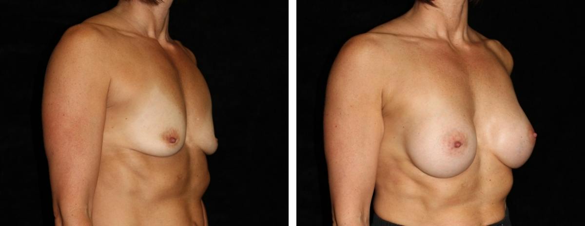 Breast Augmentation Before & After Gallery - Patient 407638 - Image 2
