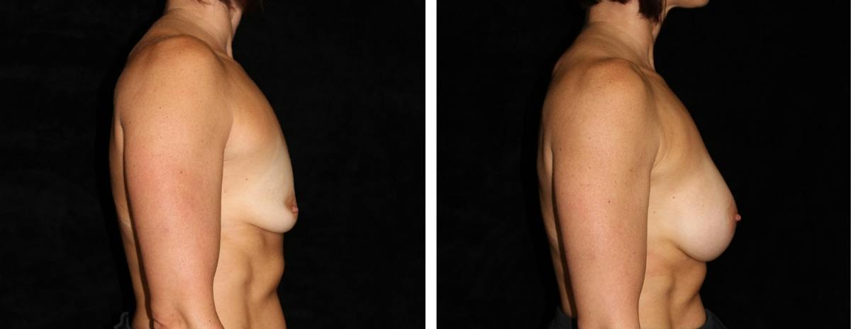 Breast Augmentation Before & After Gallery - Patient 407638 - Image 3