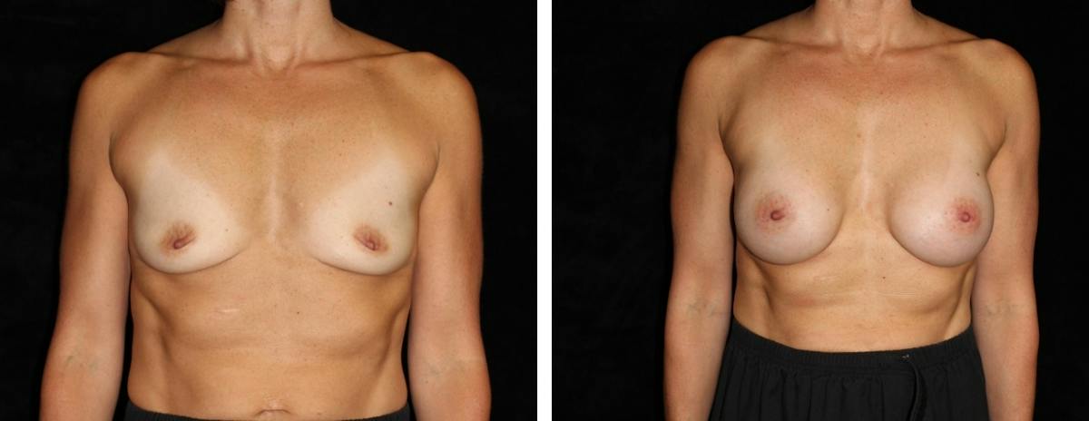 Breast Augmentation Before & After Gallery - Patient 407638 - Image 1