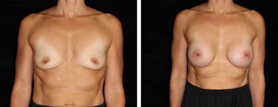 Breast Augmentation Before & After Gallery - Patient 407638 - Image 1