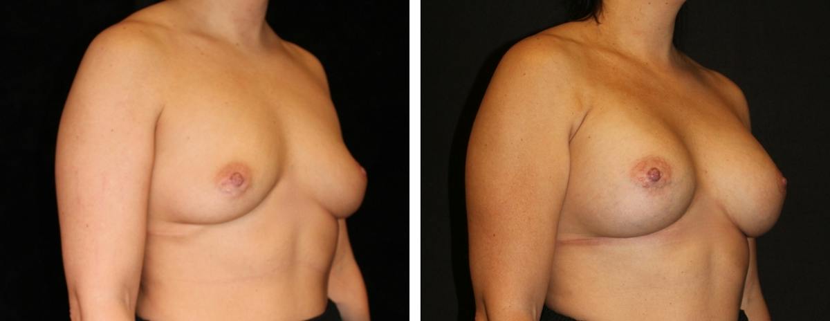 Breast Augmentation Before & After Gallery - Patient 191336 - Image 2