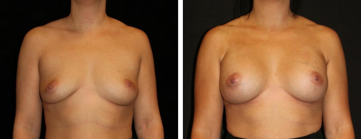 Breast Augmentation Before & After Gallery - Patient 191336 - Image 1