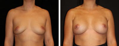 Breast Augmentation Before & After Gallery - Patient 191336 - Image 1