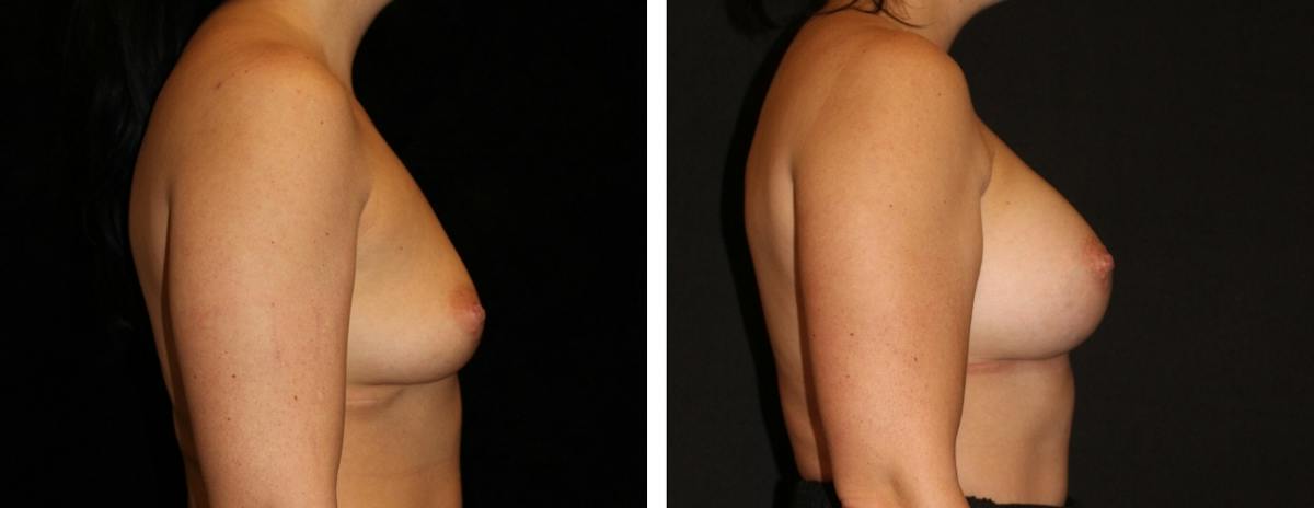 Breast Augmentation Before & After Gallery - Patient 191336 - Image 3