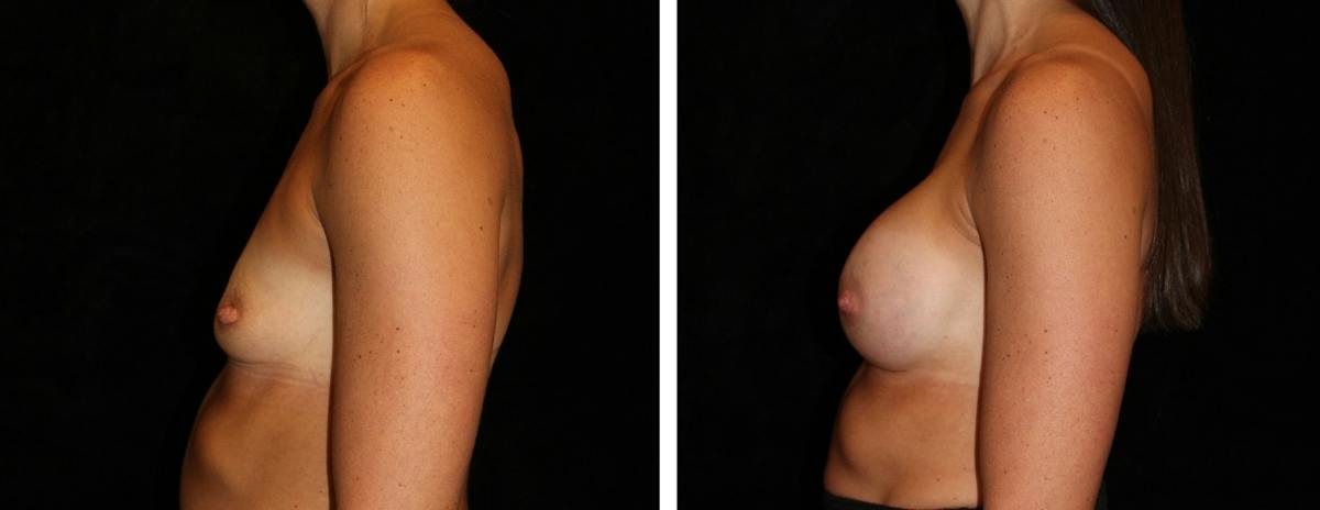 Breast Augmentation Before & After Gallery - Patient 402169 - Image 3