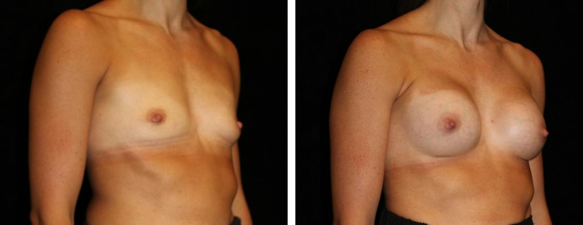 Breast Augmentation Before & After Gallery - Patient 402169 - Image 2