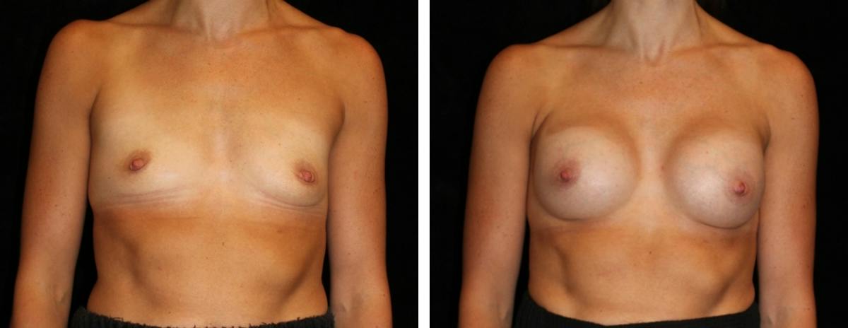 Breast Augmentation Before & After Gallery - Patient 402169 - Image 1