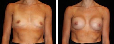 Breast Augmentation Before & After Gallery - Patient 402169 - Image 1