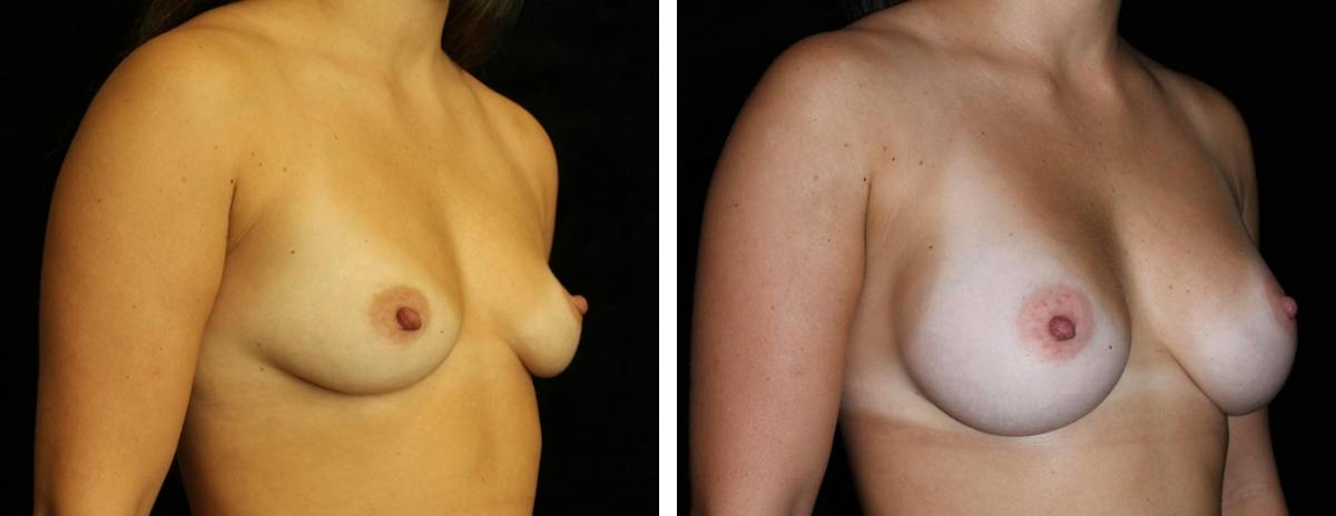 Breast Augmentation Before & After Gallery - Patient 486702 - Image 2