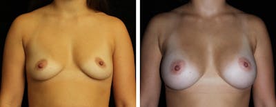 Breast Augmentation Before & After Gallery - Patient 486702 - Image 1