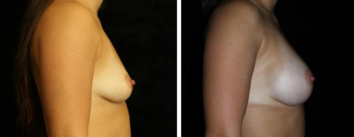 Breast Augmentation Before & After Gallery - Patient 486702 - Image 3