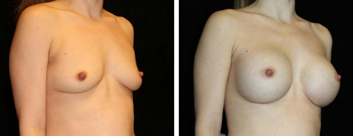 Breast Augmentation Before & After Gallery - Patient 417715 - Image 2