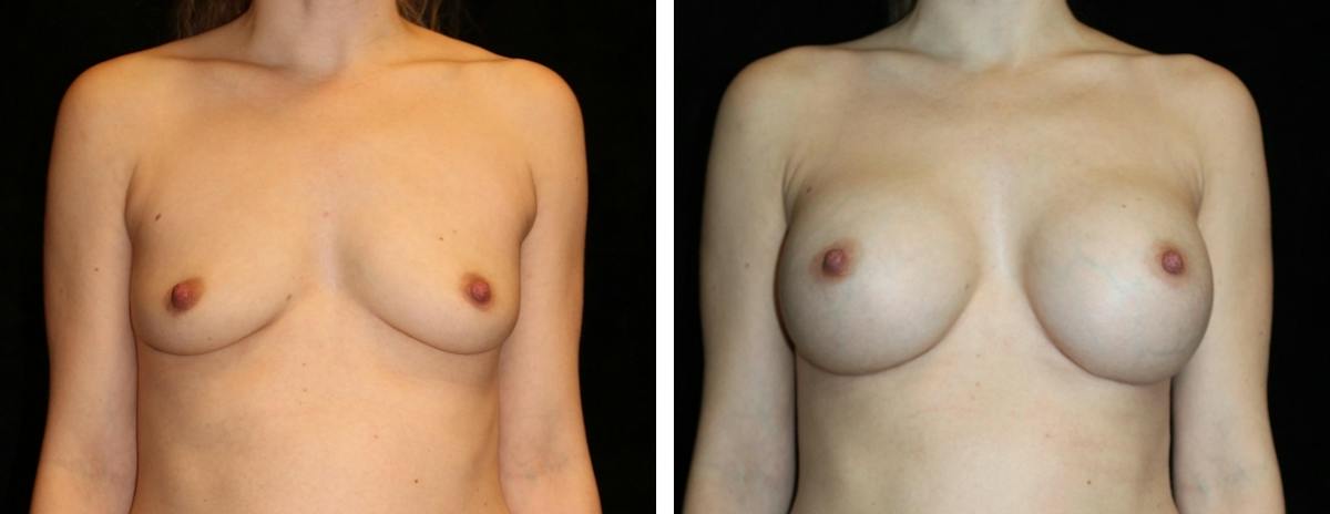 Breast Augmentation Before & After Gallery - Patient 417715 - Image 1