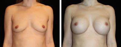 Breast Augmentation Before & After Gallery - Patient 417715 - Image 1