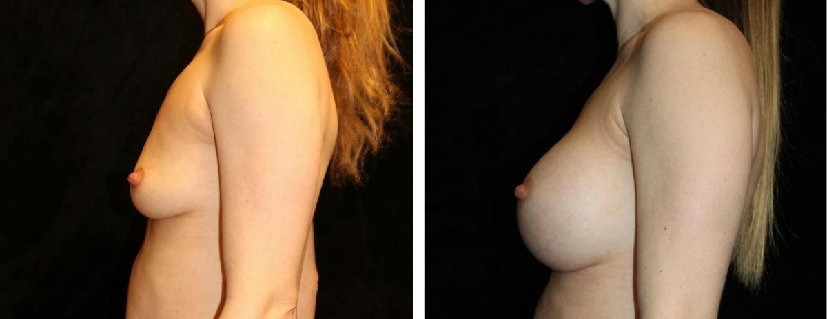 Breast Augmentation Before & After Gallery - Patient 417715 - Image 3