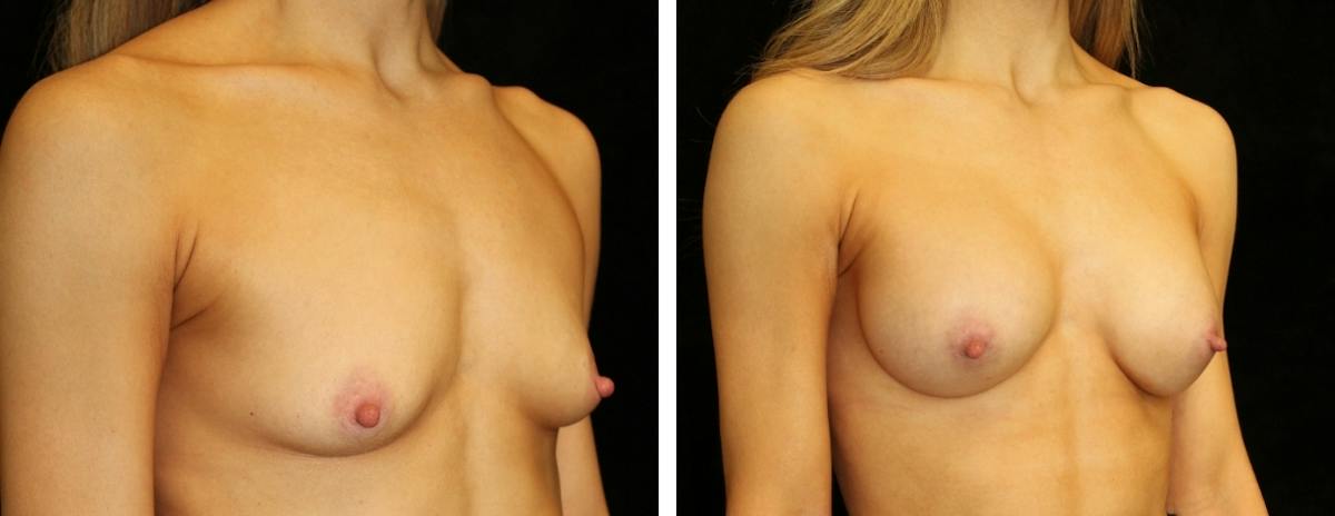 Breast Augmentation Before & After Gallery - Patient 357744 - Image 2