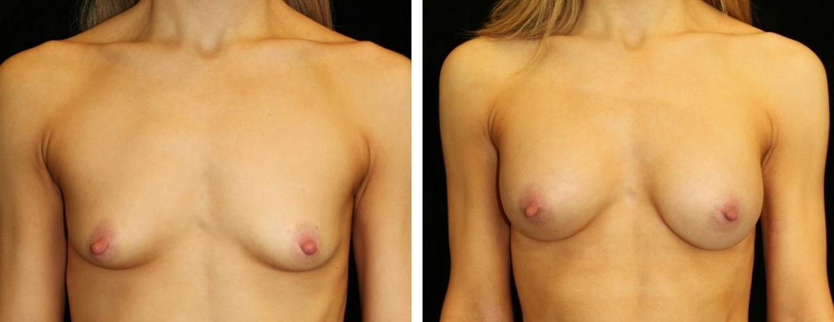Breast Augmentation Before & After Gallery - Patient 357744 - Image 1