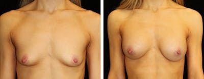 Breast Augmentation Before & After Gallery - Patient 357744 - Image 1