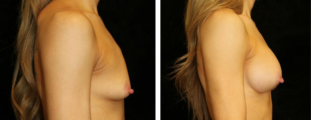 Breast Augmentation Before & After Gallery - Patient 357744 - Image 3