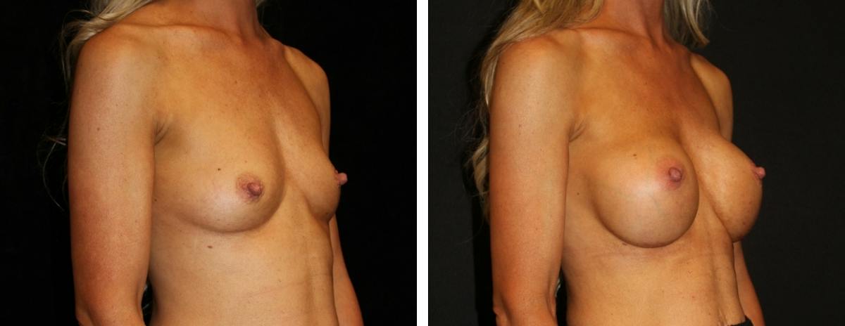 Breast Augmentation Before & After Gallery - Patient 254517 - Image 2