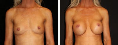 Breast Augmentation Before & After Gallery - Patient 254517 - Image 1